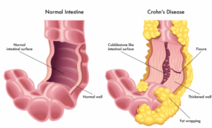 Crohn’s Disease